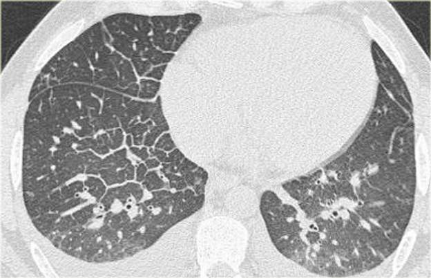 chest CT