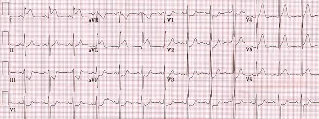 Image result for ekg acute mi