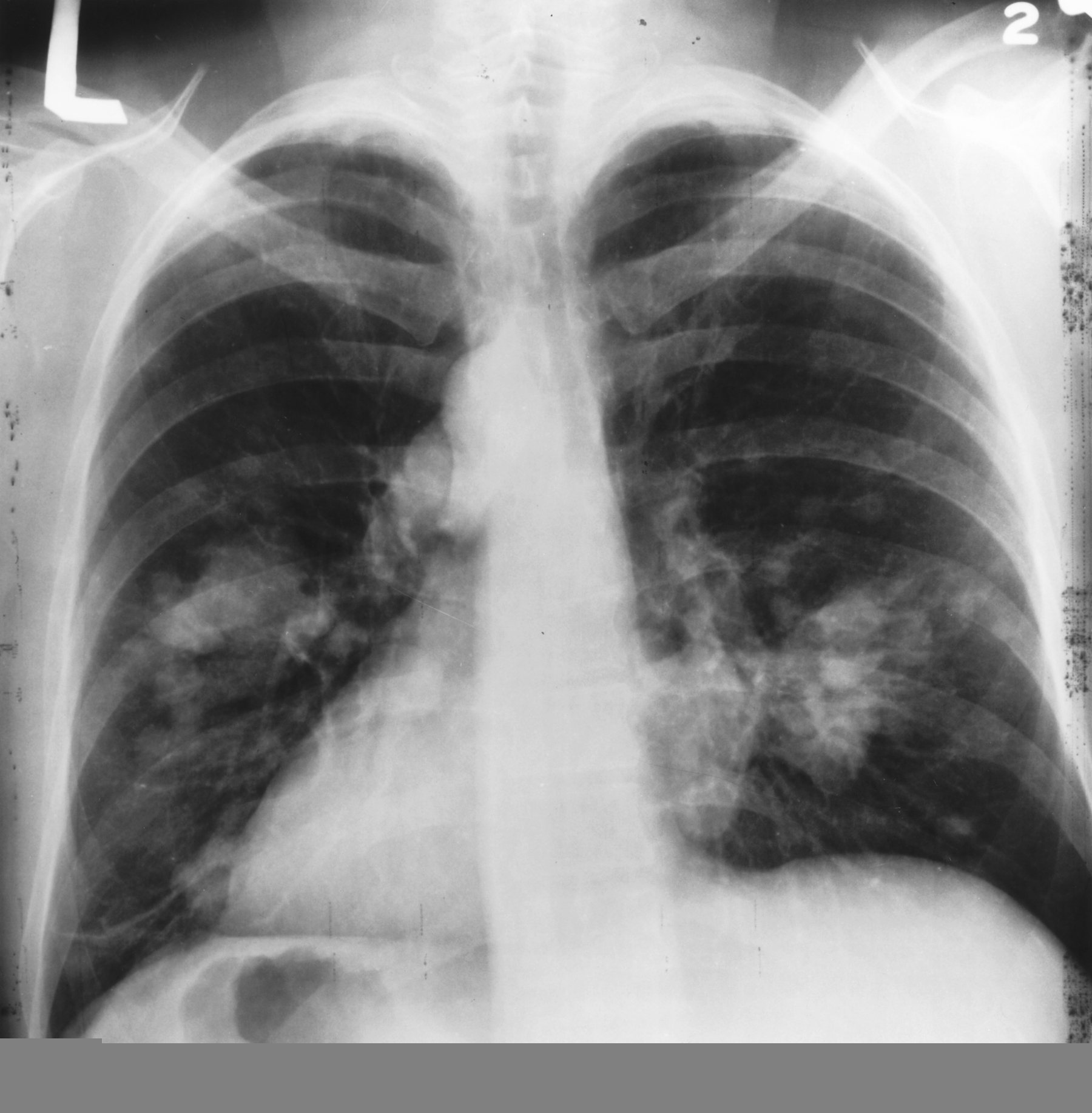 CXR