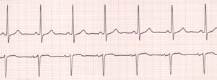 Normal Sinus Rhythm