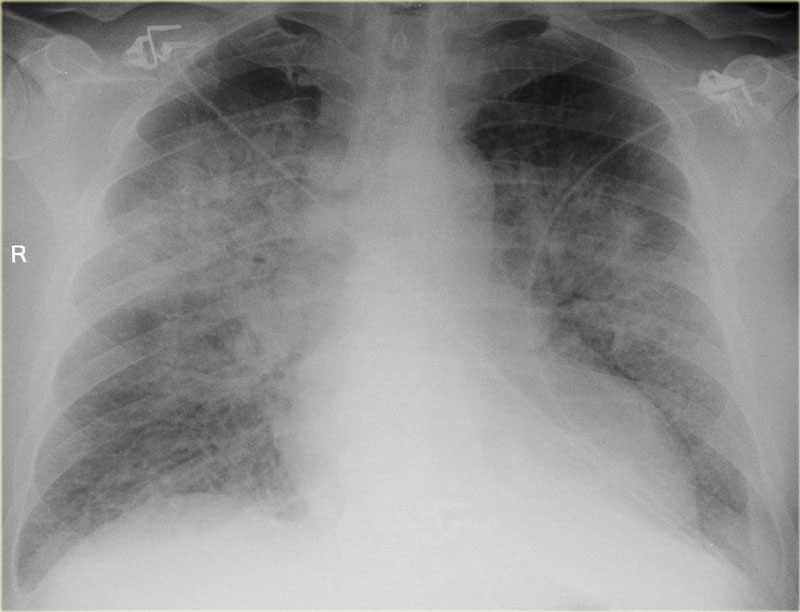 CXR