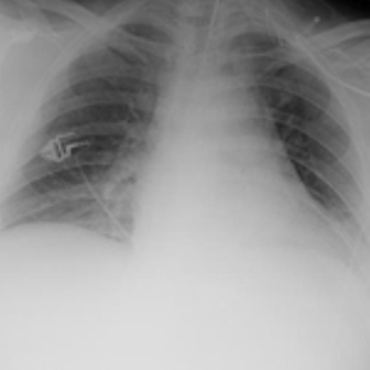 PA CXR pneumonia