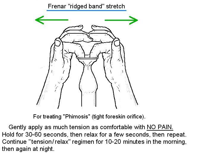 Frenulum breve, foreskin doesnt fully retract when penis 